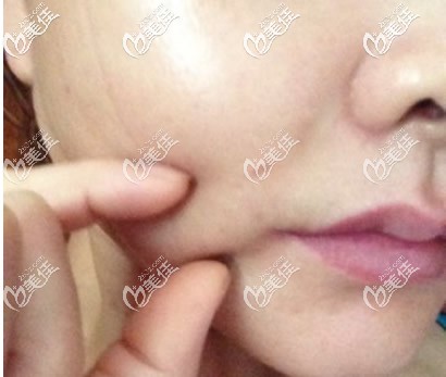 嘴角兩側(cè)有肉凸起圖片 嘴角兩側(cè)有肉凸起圖片