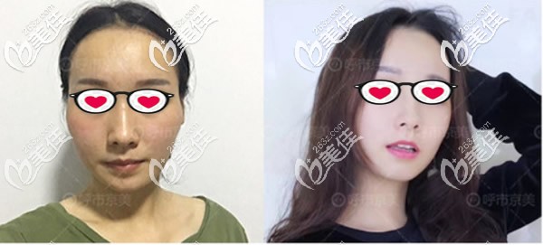 面部脂肪膠填充+埋線提升后醫(yī)生讓我?guī)ь^套,會(huì)不會(huì)把移植的脂肪壓死呀?