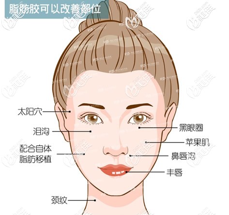 脂肪膠可以改善哪些部位 脂肪膠可以改善哪些部位