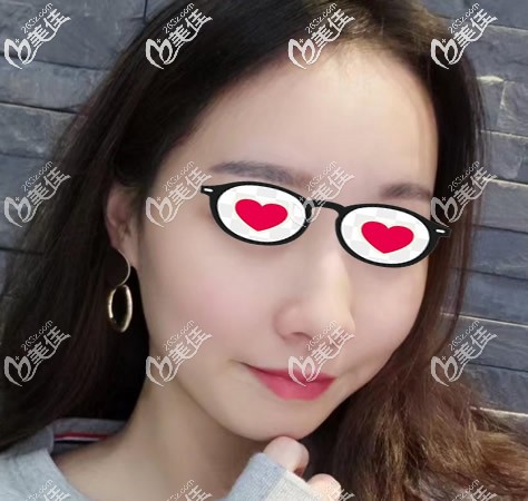 呼市京美劉攀龍面部脂肪膠填充+埋線(xiàn)提升恢復(fù)圖 呼市京美劉攀龍面部脂肪膠填充+埋線(xiàn)提升恢復(fù)圖