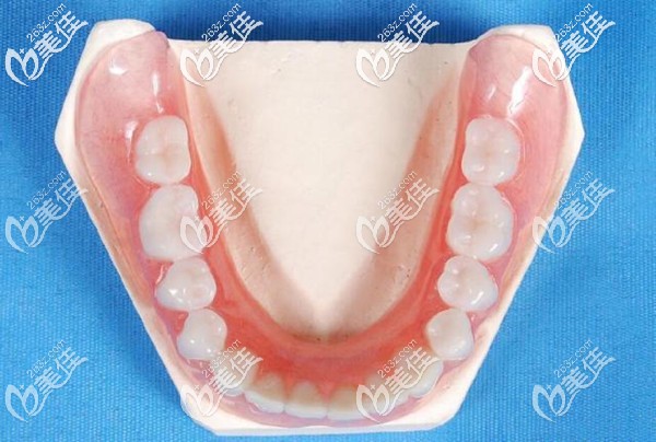 活動(dòng)假牙 活動(dòng)假牙