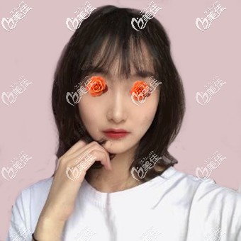 玻尿酸填充下巴術(shù)后3天照