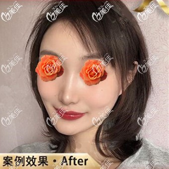 在沈陽元辰注射潤百顏玻尿酸填充下巴快半年了，效果真的很不錯！