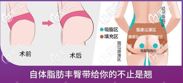 自體脂肪豐胸前后對比照片