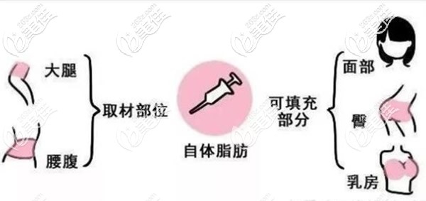 大腿和腰腹的脂肪可以填充到臀部胸部和面部