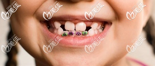 千萬別給小孩矯正牙齒