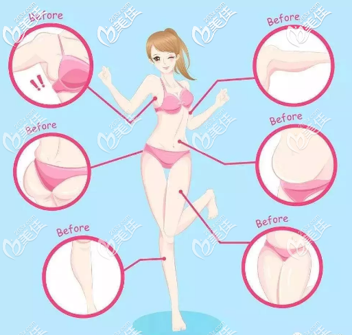 5G天使光雕適合的吸脂部位 5G天使光雕適合的吸脂部位