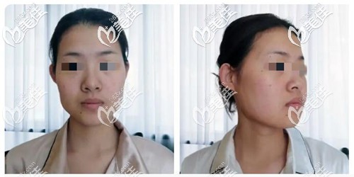 下頜角整形手術前 下頜角整形手術前