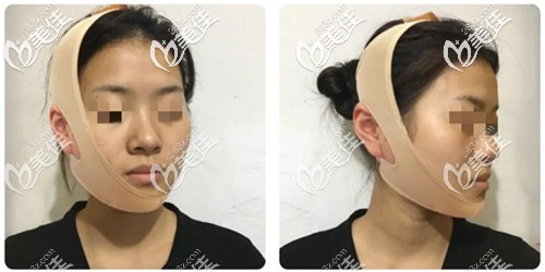下頜角整形手術恢復1個月 下頜角整形手術恢復1個月