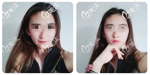 下頜角整形手術恢復三個月 下頜角整形手術恢復三個月