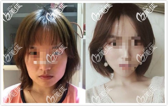 真人案例：顴骨內(nèi)推加下頜骨削骨一年后對(duì)比照片