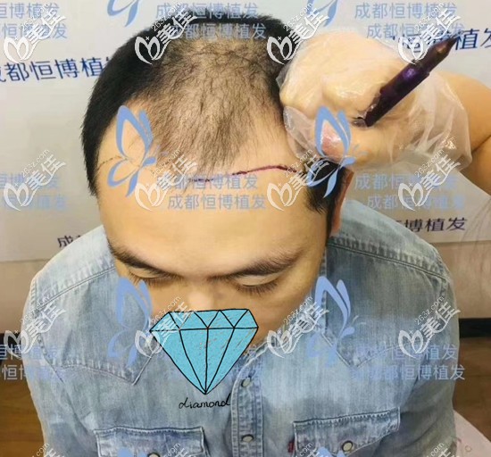 毛囊檢測后醫(yī)生為我設(shè)計手術(shù)方案 毛囊檢測后醫(yī)生為我設(shè)計手術(shù)方案