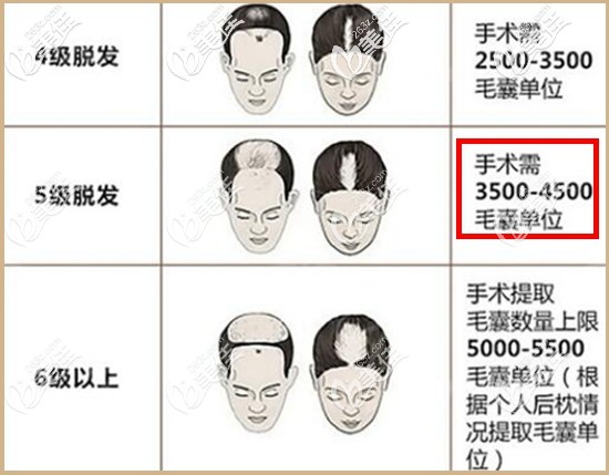 5級脫發(fā)植發(fā)4000單位夠么 5級脫發(fā)植發(fā)4000單位夠么