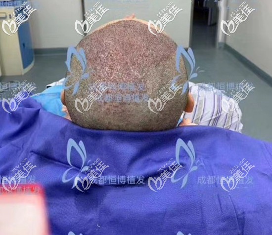 5級(jí)脫發(fā)4000單位夠么?展示五級(jí)脫發(fā)頭頂稀疏加密植發(fā)4000毛囊單位效果圖