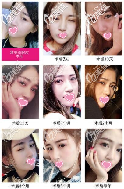 衡陽雅美廖偉龍雙眼皮整形真人案例照