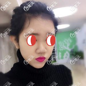 做隆鼻手術(shù)前自己的塌鼻子 做隆鼻手術(shù)前自己的塌鼻子