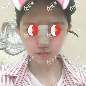 鼻綜合術(shù)后即刻鼻子變挺拔 鼻綜合術(shù)后即刻鼻子變挺拔