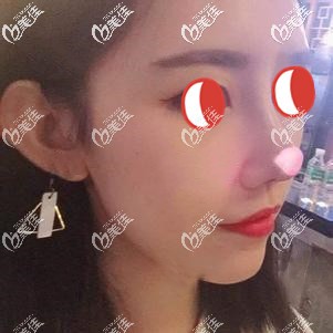 隆鼻術(shù)后25天鼻子腫脹基本消完 隆鼻術(shù)后25天鼻子腫脹基本消完