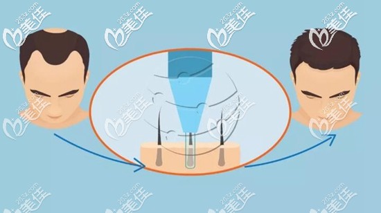 毛發(fā)移植手術(shù)的原理過程 毛發(fā)移植手術(shù)的原理過程