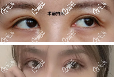 西安的妹子一定要了解米蘭柏羽王建新醫(yī)生眼部修復(fù)的技術(shù)有多好