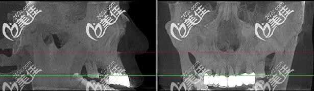杭州美奧口腔穿顴種植牙案例