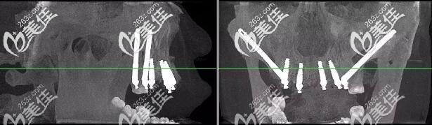 杭州美奧口腔半口穿顴種植牙案例