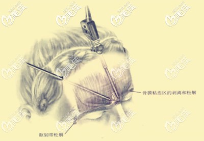 內(nèi)窺鏡面部提升手術(shù)的優(yōu)勢(shì)