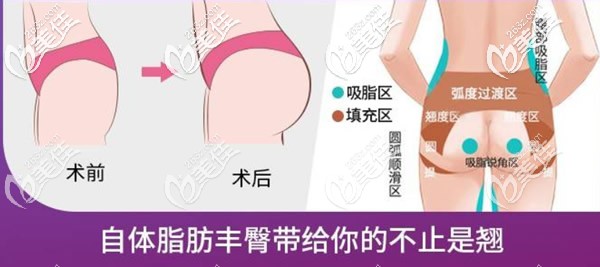 自體脂肪豐臀前后對比照片 自體脂肪豐臀前后對比照片