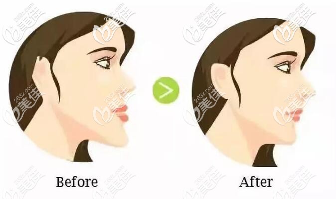 牙性加骨性地包天矯正前后差異 牙性加骨性地包天矯正前后差異