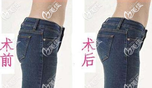 臀部抽脂手術(shù)前后照片 臀部抽脂手術(shù)前后照片