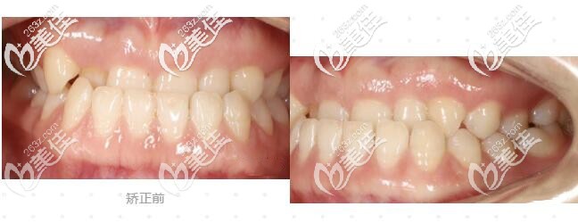 杭州齊爾口腔牙性加骨性地包天整牙前照片 杭州齊爾口腔牙性加骨性地包天整牙前照片