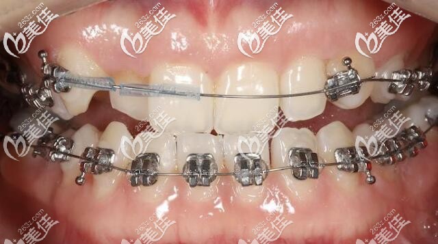 牙齒矯正剛戴牙套的照片 牙齒矯正剛戴牙套的照片