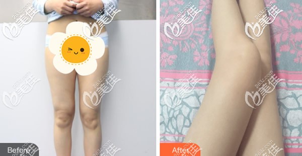 大腿吸脂前后對(duì)比照片