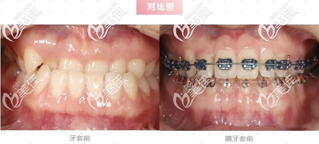 我來發(fā)表下杭州齊爾做牙齒矯正怎么樣吧，我的牙性+骨性地包天矯正前后對(duì)比照真的很難忘呀