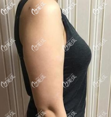 蘭州時(shí)光整形醫(yī)院手臂吸脂前 蘭州時(shí)光整形醫(yī)院手臂吸脂前