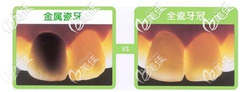 烤瓷牙和全瓷牙區(qū)別圖