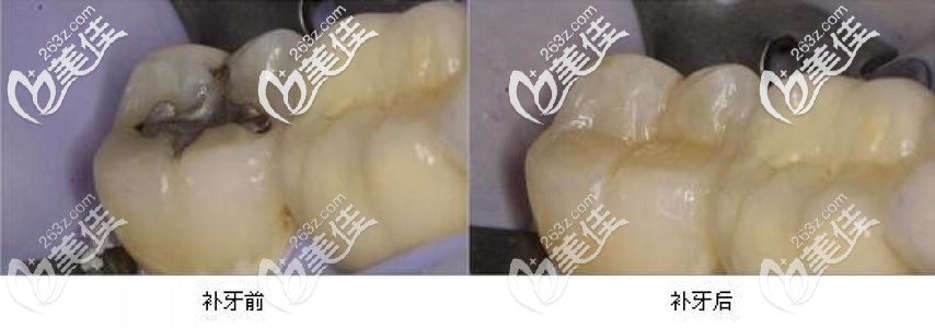 補(bǔ)牙前后對(duì)比圖