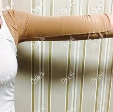 蘭州時(shí)光胳膊吸脂7天恢復(fù)圖 蘭州時(shí)光胳膊吸脂7天恢復(fù)圖