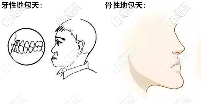 牙性和骨性地包天區(qū)別圖 牙性和骨性地包天區(qū)別圖