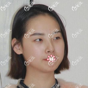 原來我單眼皮腫炮眼 原來我單眼皮腫炮眼