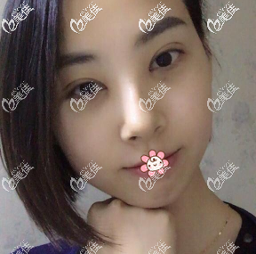 拆完線了 拆完線了