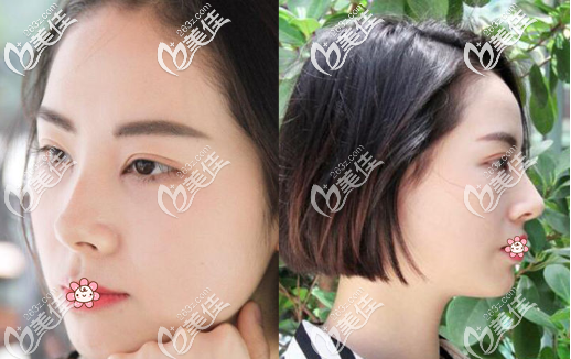 重慶光博士全切雙眼皮一個月 重慶光博士全切雙眼皮一個月