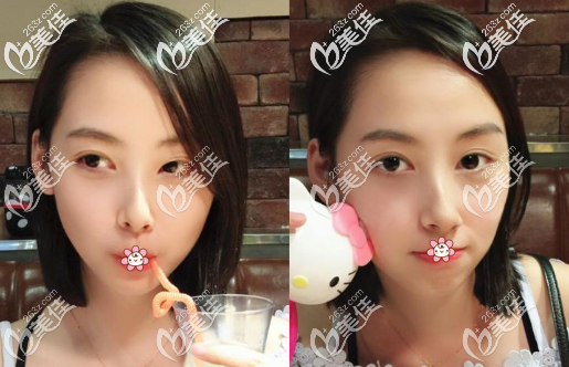 看完重慶這家做的開扇型全切雙眼皮+開內眼角圖片就明白8mm雙眼皮恢復好了多寬