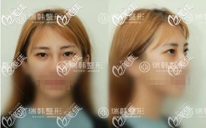 做瑞韓蘿莉大眼術(shù)前照 做瑞韓蘿莉大眼術(shù)前照