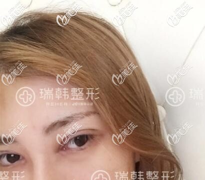 做瑞韓蘿莉大眼術(shù)后5天恢復(fù)照 做瑞韓蘿莉大眼術(shù)后5天恢復(fù)照