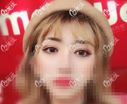 做瑞韓蘿莉大眼術(shù)后20天恢復(fù)效果照 做瑞韓蘿莉大眼術(shù)后20天恢復(fù)效果照