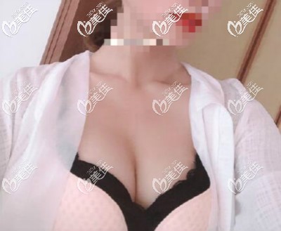 自體脂肪豐胸三四年后吸收從C變回A杯,我又做了寶儷假體250cc后大小才滿意