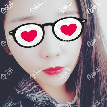 我在蘭州崔大夫面部埋線提升7天恢復(fù)過程圖片