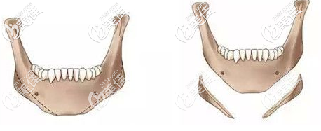 長(zhǎng)曲線(xiàn)下頜角手術(shù)效果