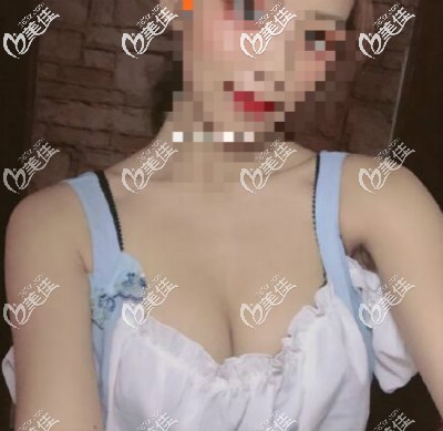 自體脂肪隆胸三個(gè)月療效圖片